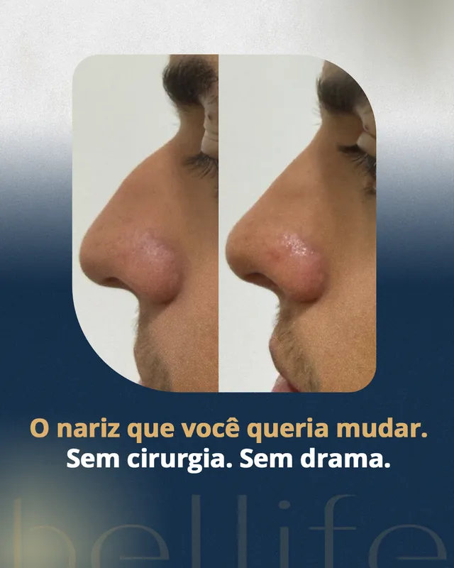 Arte para redes sociais da Bellife Macapá: O nariz que você queria mudar, sem cirurgia